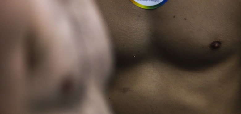 Ποια είναι τα αίτια της γυναικομαστίας και πώς αντιμετωπίζεται…