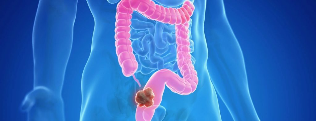 Καρκίνος του παχέος εντέρου: Το γρήγορο περπάτημα μπορεί να μειώσει τον κίνδυνο θανάτου